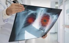  Lung Cancer Specialist in Nagpur - Dr. Sameeksha Dubey Dr. Sameeksha Dubey is a renowned lung cancer specialist in Nagpur, offering expert diagnosis and personalized treatment plans. With extensive experience, she provides compassionate care and advanced therapies to help patients combat lung cancer effectively, ensuring optimal outcomes and improved quality of life. For more visit us! Visit us : https://g.co/kgs/8SynDn1 