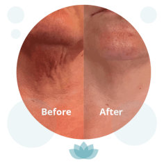  Looking to rejuvenate your skin with lasting hydration and glow? RejuvaMed Skin Clinic offers advanced Profhilo treatments tailored for natural results. Known for boosting collagen and elastin, Profhilo is a non-surgical solution ideal for dull or aging skin. Curious about the Profhilo treatment price UK? Our expert team provides transparent pricing and personalised care to help you achieve radiant, youthful skin with confidence. Book your consultation today and feel the difference. 