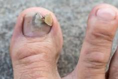  At Dr. TJ Ahn’s Foot & Ankle Clinic , patients across Chicagoland receive expert care for a wide range of foot conditions delivered with compassion, precision, and a modern touch. Whether you’re struggling with chronic heel pain, flat feet, bunions, or ingrown toenails, Dr. Ahn combines advanced diagnostic tools with minimally invasive surgical solutions and concierge-style service to restore your mobility and comfort. 
